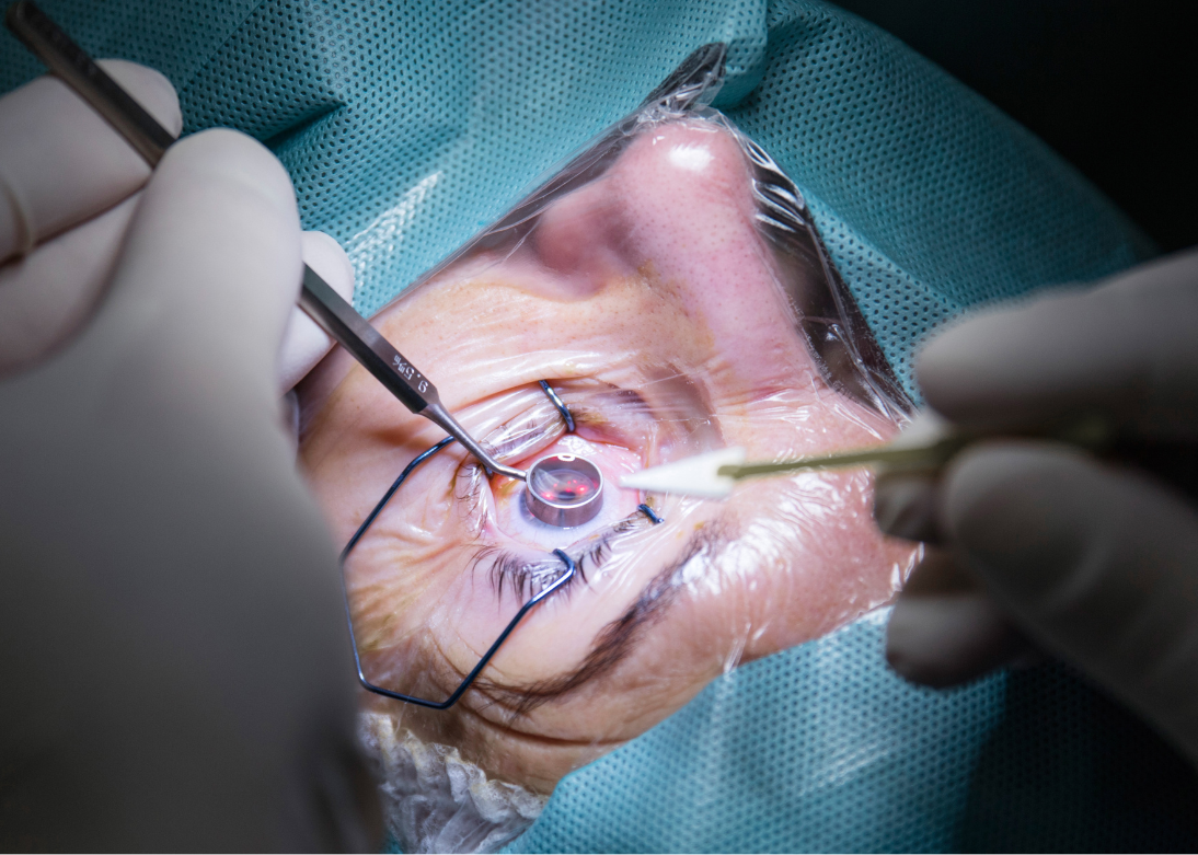 Refractive Surgery
